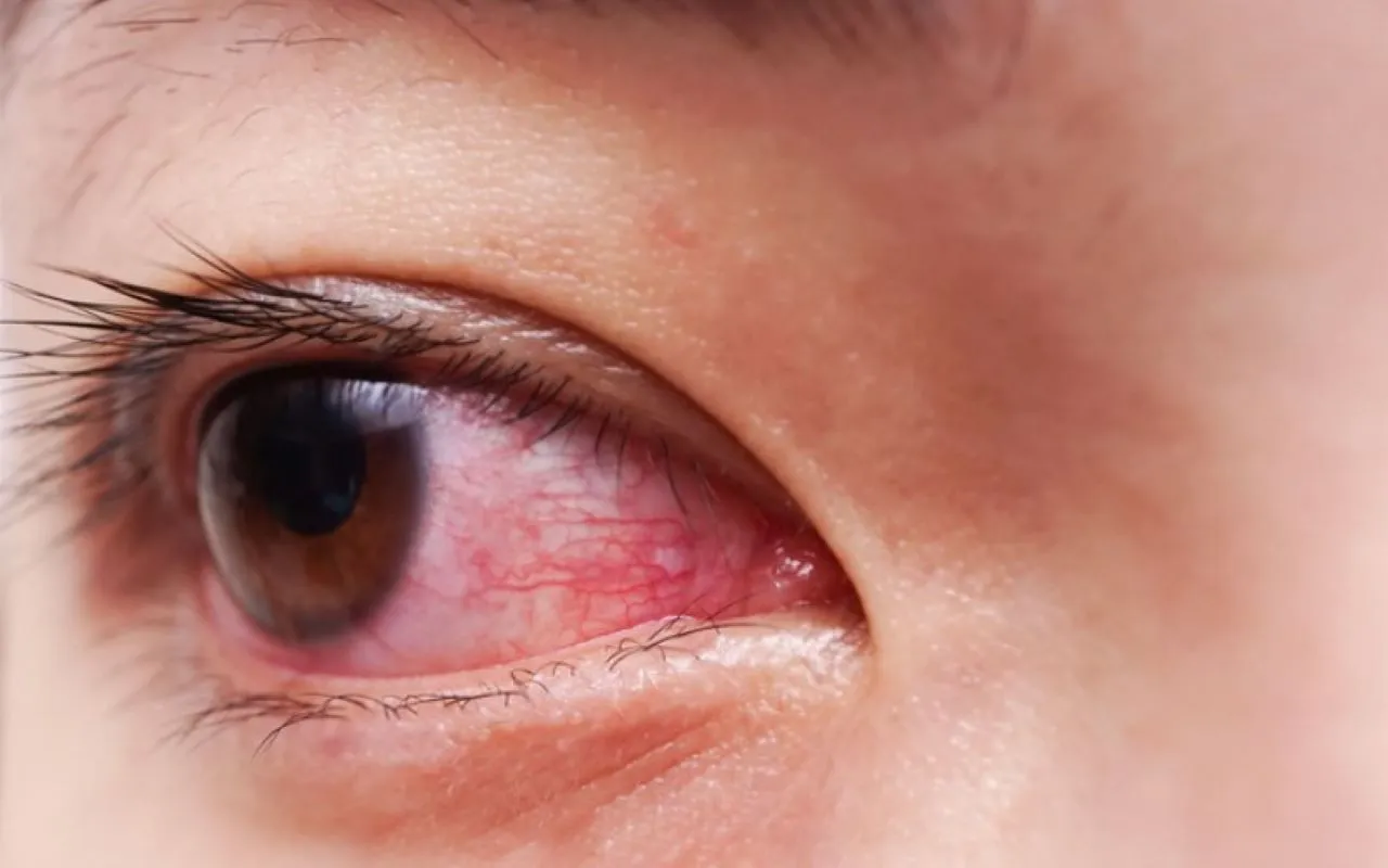 Đau mắt đỏ kiêng ăn gì để nhanh khỏi? Những lưu ý cần biết để tránh biến chứng